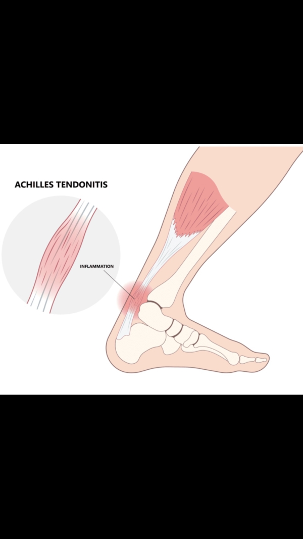 Injured? Does rest and ice help you recover?