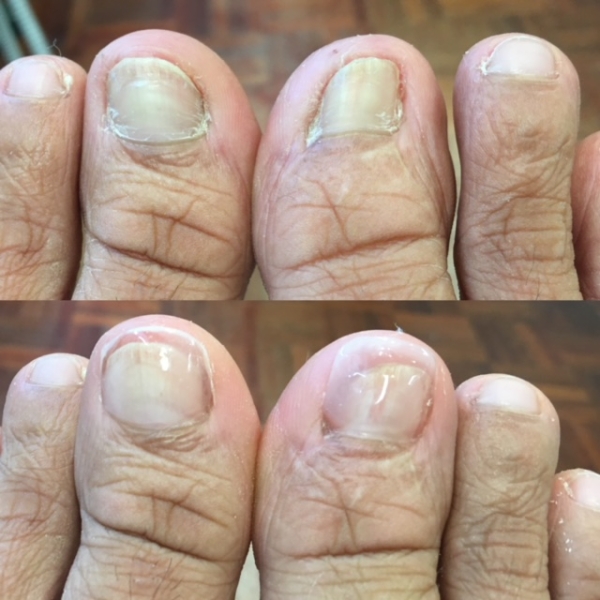 Keryflex Nail Restoration